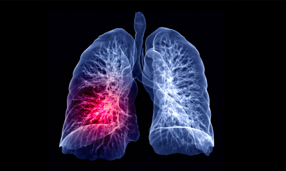 90 Percent of Long COVID Occurs in Mild COVID-19 Cases: Study Data